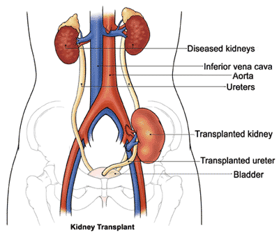 Hemodialysis and Peritoneal Dialysis