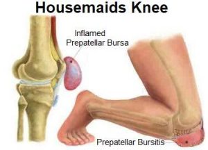 Knee Bursitis Treatment