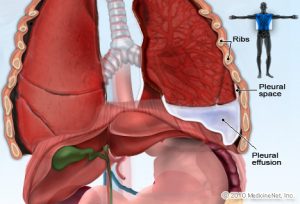 Pleurisy Diagnosis