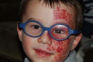 Sturge Weber Syndrome (SWS) Treatment